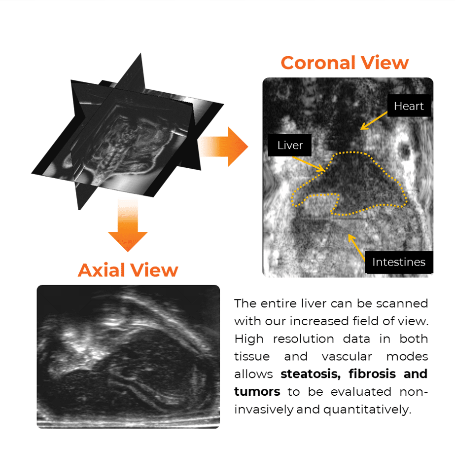 liver fibrosis ultrasound